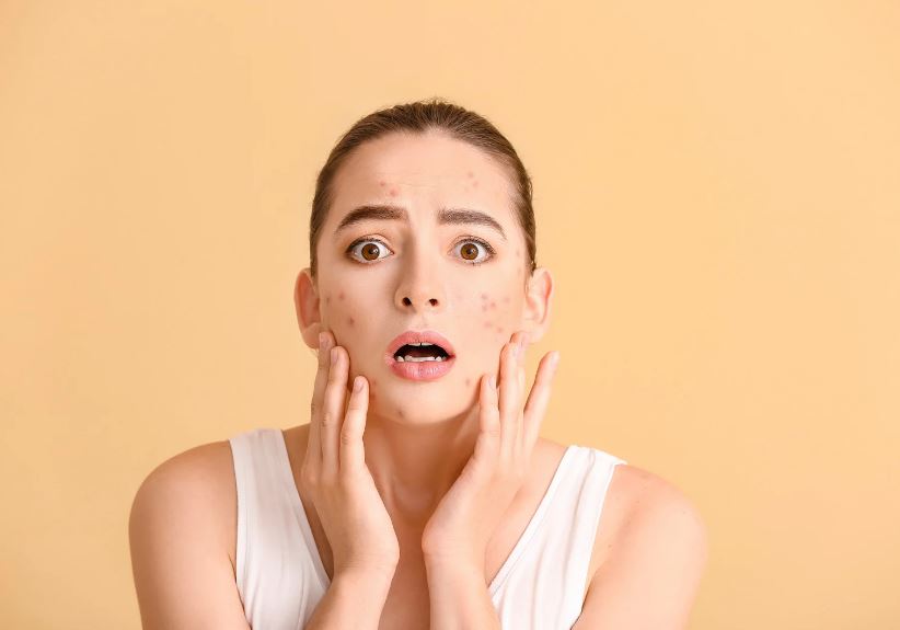 フェイスライン ニキビ