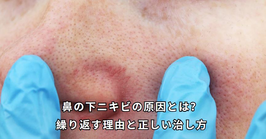 鼻の下 ニキビ 原因